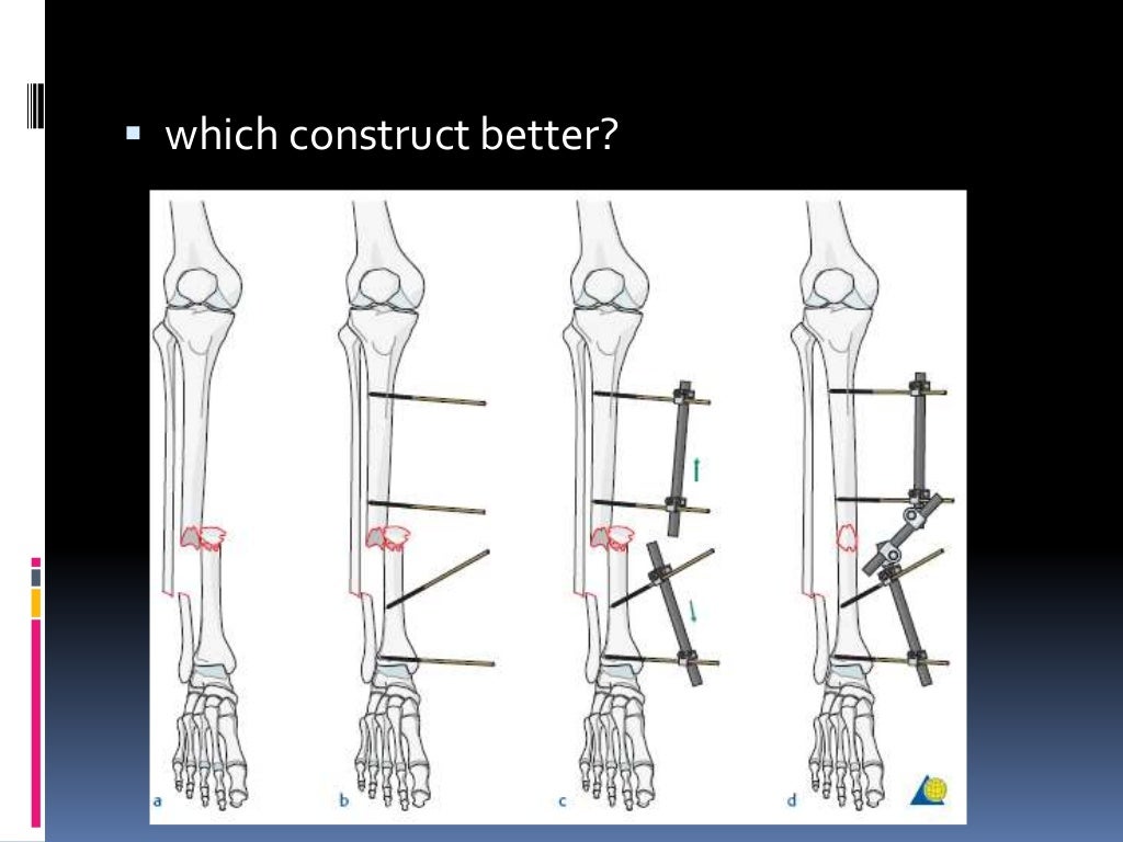 principles of External fixation