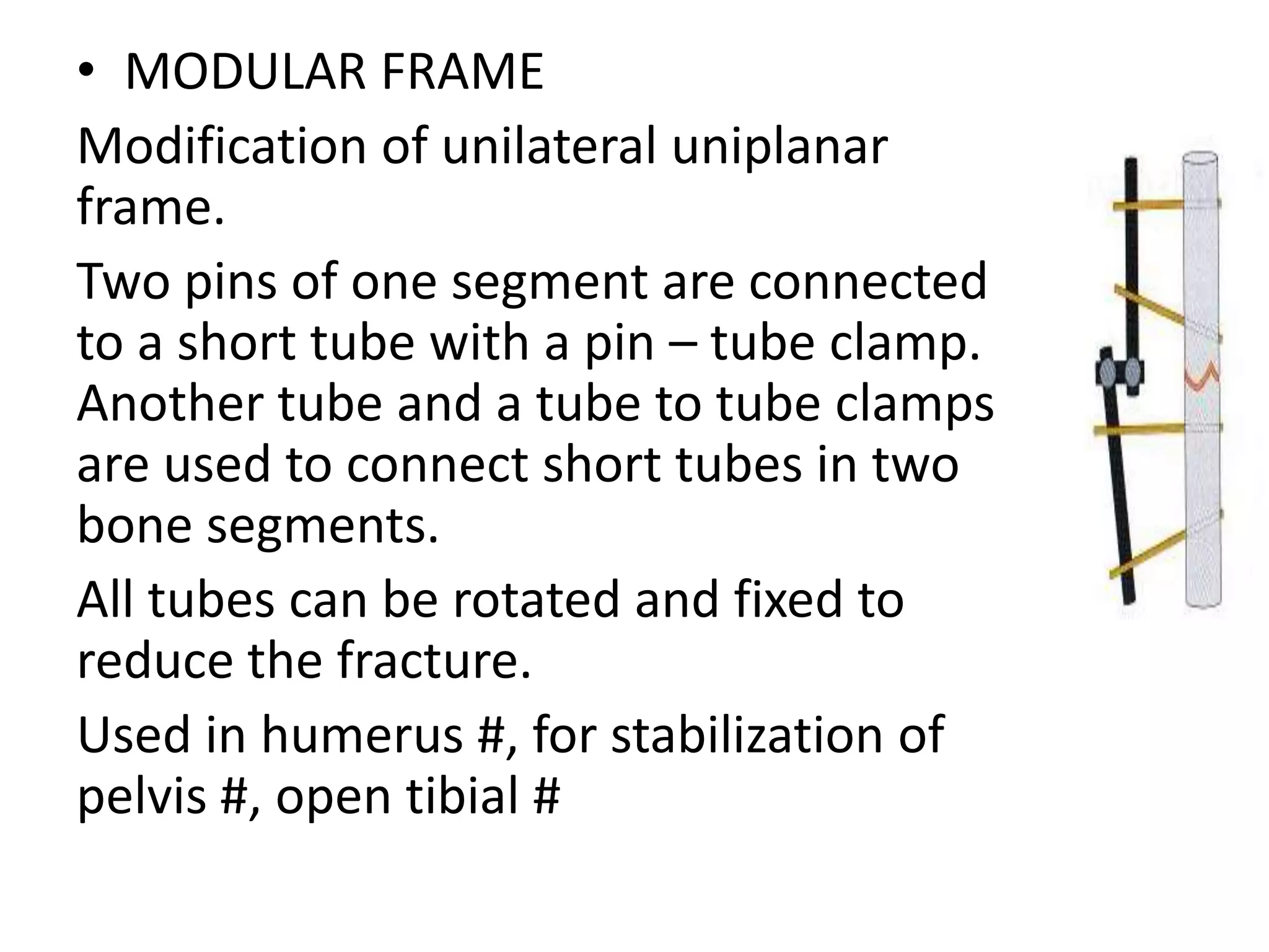 External fixator | PPTX