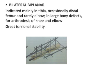 • BILATERAL BIPLANAR
Indicated mainly in tibia, occasionally distal
femur and rarely elbow, in large bony defects,
for arthrodesis of knee and elbow
Great torsional stability
 