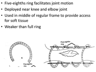 • Five-eighths ring facilitates joint motion
• Deployed near knee and elbow joint
• Used in middle of regular frame to provide access
for soft tissue
• Weaker than full ring
 