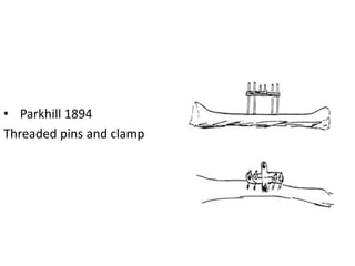 • Parkhill 1894
Threaded pins and clamp
 