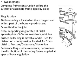 • Two methods
Complete frame construction before the
surgery or assemble frame piece by piece
Ring Position
Stationary ring is located on the strongest and
widest part of the bone – proximal end
5cms distal to the joint
Distal supporting ring located at distal
epimetaphysis 3- 5 cms away from joint line
Pusher puller ring is movable and is used for
distraction – compression, located 3 – 5 cms
distal to Fracture/Osteotomy/Non union
Reference Ring used as reference, determines
the distribution of translating forces, applied at
apex of bony angulation
 