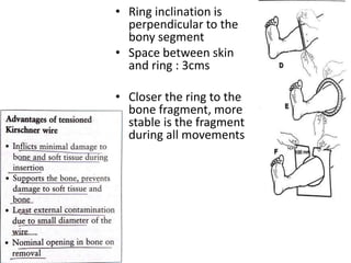 • Ring inclination is
perpendicular to the
bony segment
• Space between skin
and ring : 3cms
• Closer the ring to the
bone fragment, more
stable is the fragment
during all movements
 