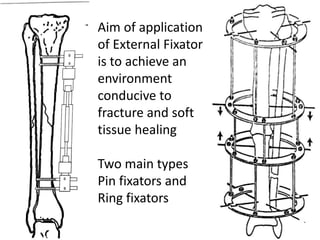 Aim of application
of External Fixator
is to achieve an
environment
conducive to
fracture and soft
tissue healing
Two main types
Pin fixators and
Ring fixators
 