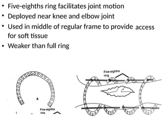 •
•
•
Five-eighths ring facilitates joint motion
Deployed near knee and elbow joint
Used in middle of regular frame to provide
for soft tissue
Weaker than full ring
access
•
 
