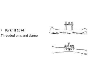• Parkhill 1894
Threaded pins and clamp
 