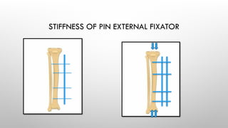 Principles External Fixator EXTERNAL FIXATORS principles of exfix .pptx