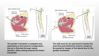 EXTERNAL FIXATORS principles of exfix .pptx