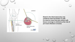 EXTERNAL FIXATORS principles of exfix .pptx