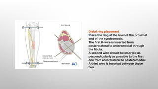 EXTERNAL FIXATORS principles of exfix .pptx