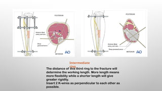 EXTERNAL FIXATORS principles of exfix .pptx