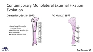 External fixation principles in orthopedic surgery | PDF