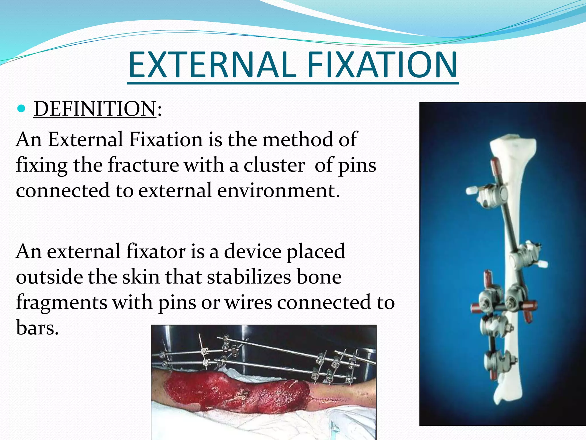 External, internal fixation, DCP and Cast Syndrome | PPTX