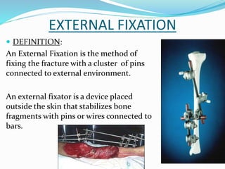EXTERNAL FIXATION
 DEFINITION:
An External Fixation is the method of
fixing the fracture with a cluster of pins
connected to external environment.
An external fixator is a device placed
outside the skin that stabilizes bone
fragments with pins or wires connected to
bars.
 