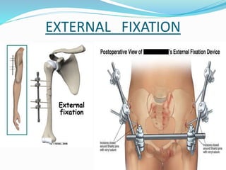 EXTERNAL FIXATION
 