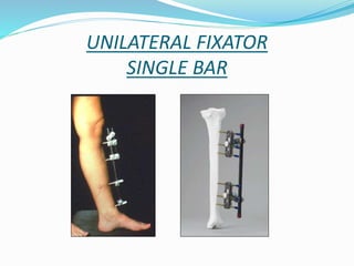 UNILATERAL FIXATOR
SINGLE BAR
 