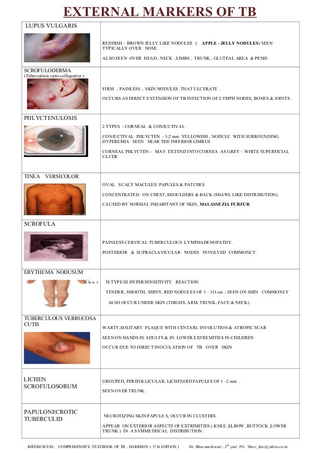 External markers of tuberculosis