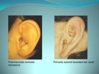 Post-traumatic auricular hematoma        Primarily sutured lacerated ear canal.