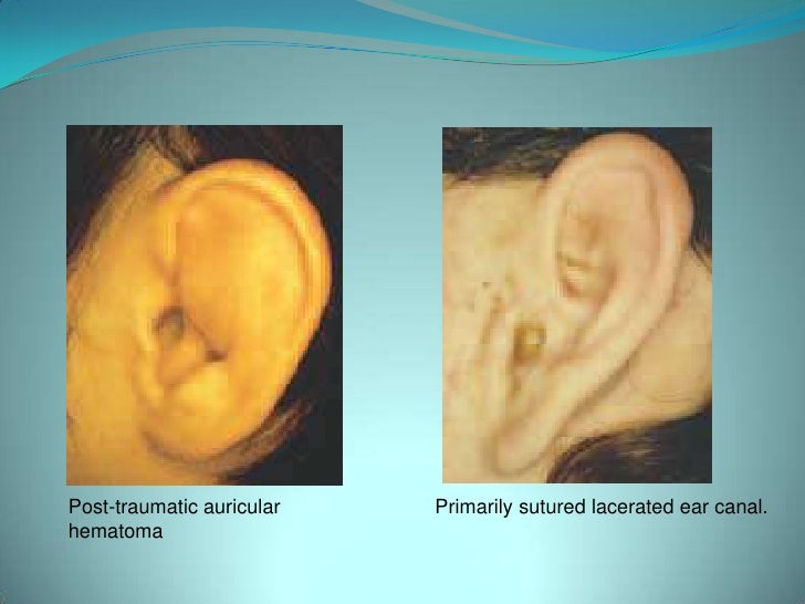 External, middle and inner ear traumas
