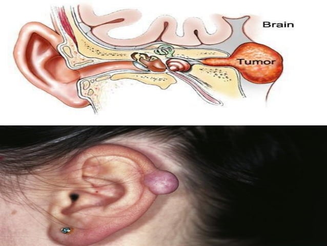 External middle inner-ear-tumor-OM VERMA.pdf