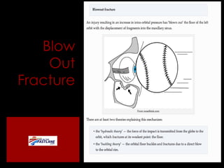 Blow Out Fracture 