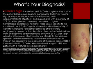 What ’s Your Diagnosis? Cullen's Sign     The patient exhibits Cullen's sign - ecchymosis in the periumbilical region. In ...