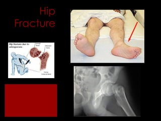 Hip Fracture 