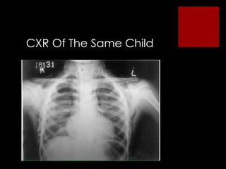 CXR Of The Same Child 
