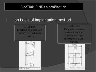 FIXATION PINS : classification  on basis of implantation method  HALF PIN   penetrate only one skin  surface but both bone cortices FULL PIN Panetrate one skin  surface then both  cortices ,and then  the opposite Skin  Surface  