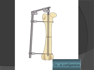 Tie –in configuration   