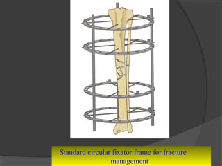 Standard circular fixator frame for fracture  management  