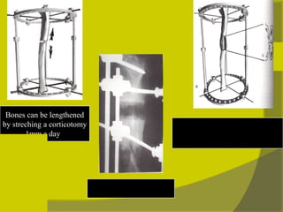 Bones can be lengthened by streching a corticotomy 1mm a day   The regenerate is composed  of  Microcolumns originating from  both bone ends  Radiograph of distraction  Callus at 3 wks  