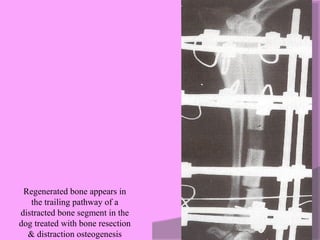 Regenerated bone appears in  the trailing pathway of a  distracted bone segment in the  dog treated with bone resection  & distraction osteogenesis  