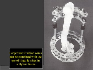 Larger transfixation wires  can be combined with the  use of rings & wires in  a Hybrid frame  