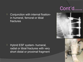 Cont’d…… Conjunction with internal fixation- in humeral, femoral or tibial fractures  Hybrid ESF system- humeral, radial or tibial fractures with very short distal or proximal fragment  