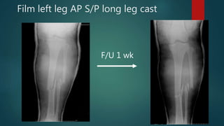 Film left leg AP S/P long leg cast
F/U 1 wk
 