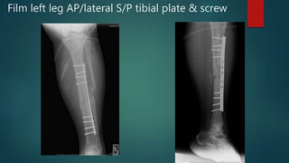 Film left leg AP/lateral S/P tibial plate & screw
 