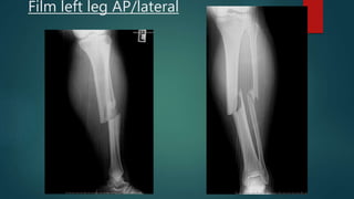 Film left leg AP/lateral
 