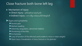 Close fracture both bone left leg
 Mechanism of injury
 Direct injury : อุบัติเหตุจักรยานยนต์ ถูกยิง
 Indirect injury : ตกจากที่สูง หกล้มขณะที่เท้าติดอยู่กับที่
Signs and symptoms
Severe pain
Marked swelling
Deformity (angulation, abnormal rotation)
Shortening of the limb
Ecchymosis
Loss of function of the affected part(unable to move or bear weight)
Open injury (visualization of bony fracture or fat globule)
 