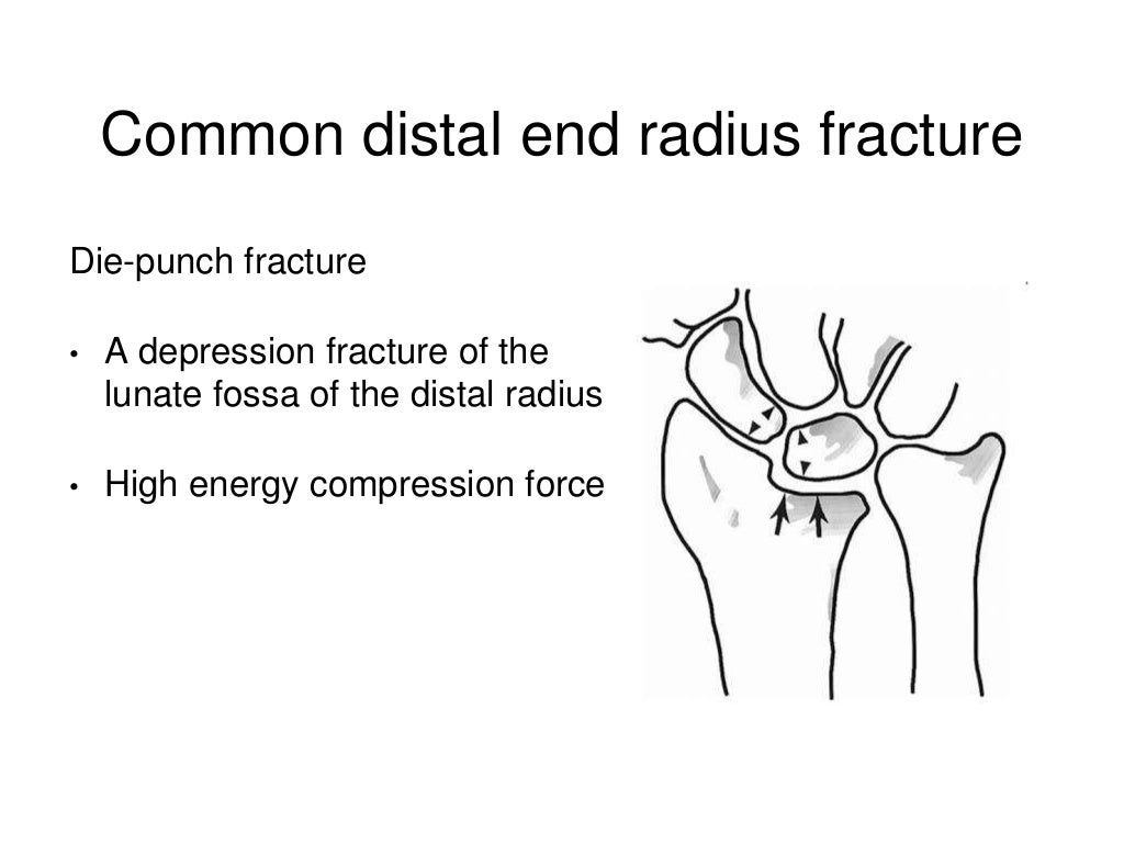 Distal end of Radius Fractures