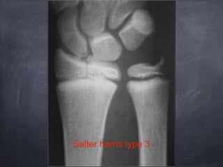 Salter harris type 3
 