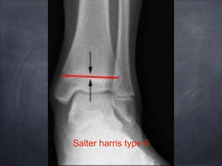 Salter harris type 5
 