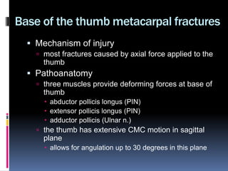 Rolando Fracture | PPTX