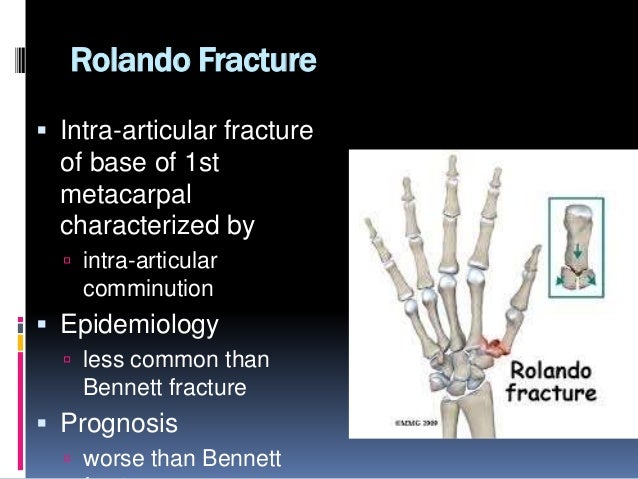 Rolando Fracture