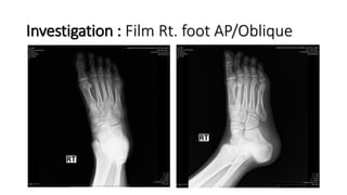 Investigation : Film Rt. foot AP/Oblique
 