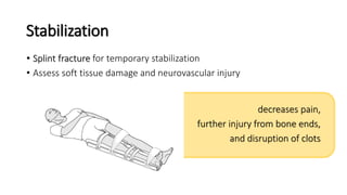Stabilization
• Splint fracture for temporary stabilization
• Assess soft tissue damage and neurovascular injury
decreases pain,
further injury from bone ends,
and disruption of clots
 