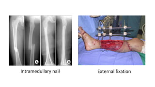 Intramedullary nail External fixation
 