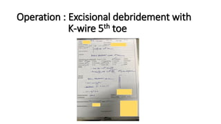 Operation : Excisional debridement with
K-wire 5th toe
 