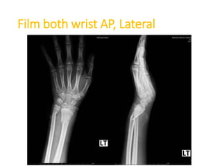 Film both wrist AP, Lateral
 