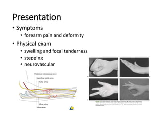 Presentation
• Symptoms
• forearm pain and deformity
• Physical exam
• swelling and focal tenderness
• stepping
• neurovascular
 
